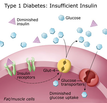 insulin diabetes type 1