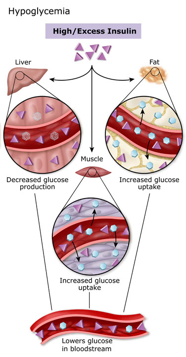 Hypoglycemia