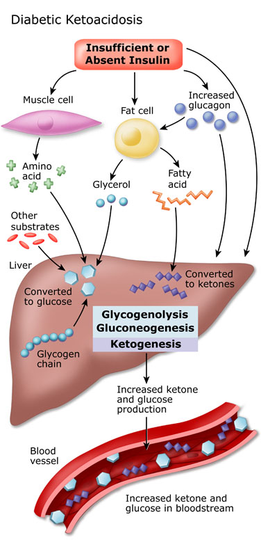 diabetic ketoacidosis