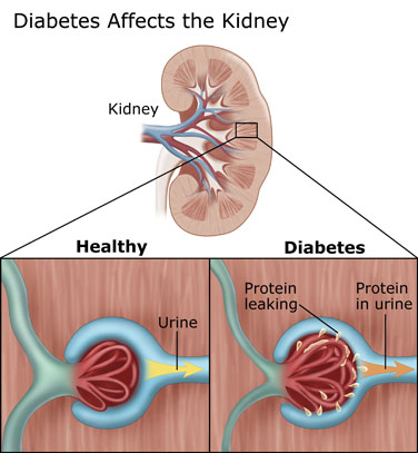 Diabetes Affects the Kidneys